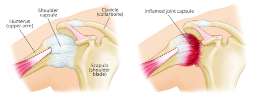 Frozen Shoulder: What It Is, Why It Happens, and How OT Can Help